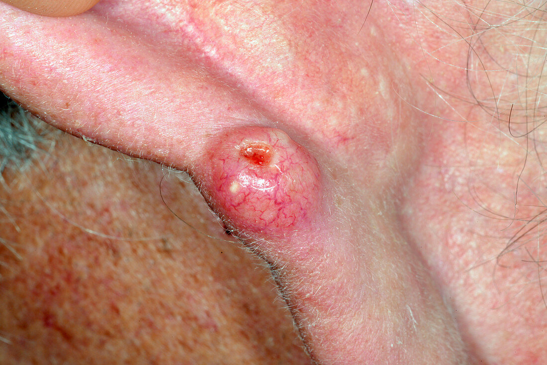 Basal-cell carcinoma skin cancer