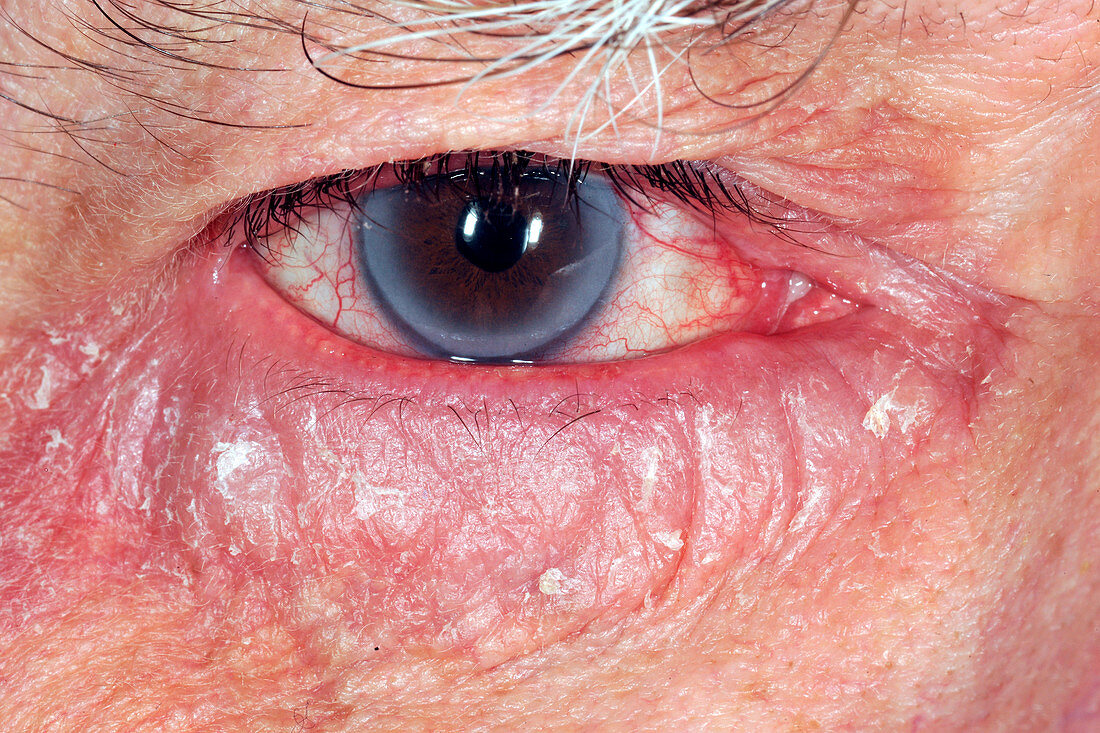 Allergic reaction in glaucoma patient