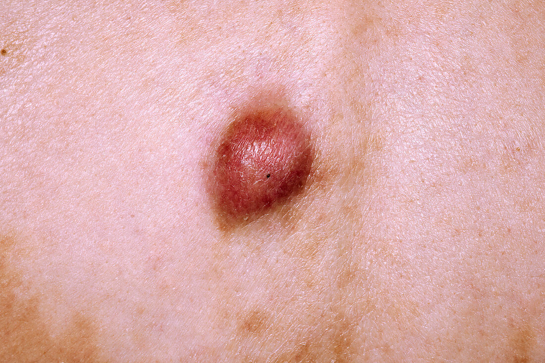 Sebaceous cyst