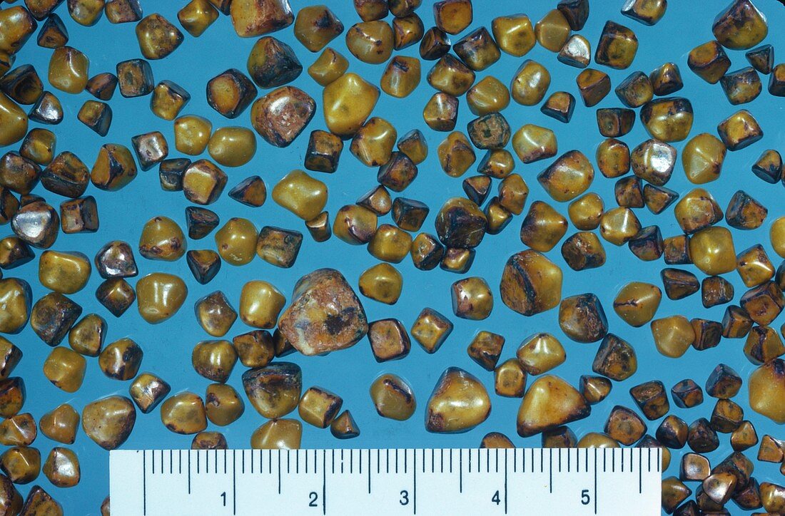Gall stones