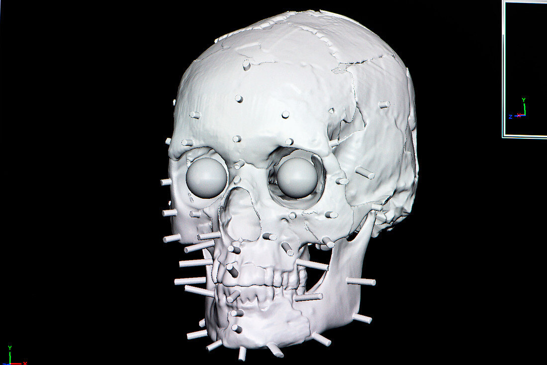 Digital forensic facial reconstruction