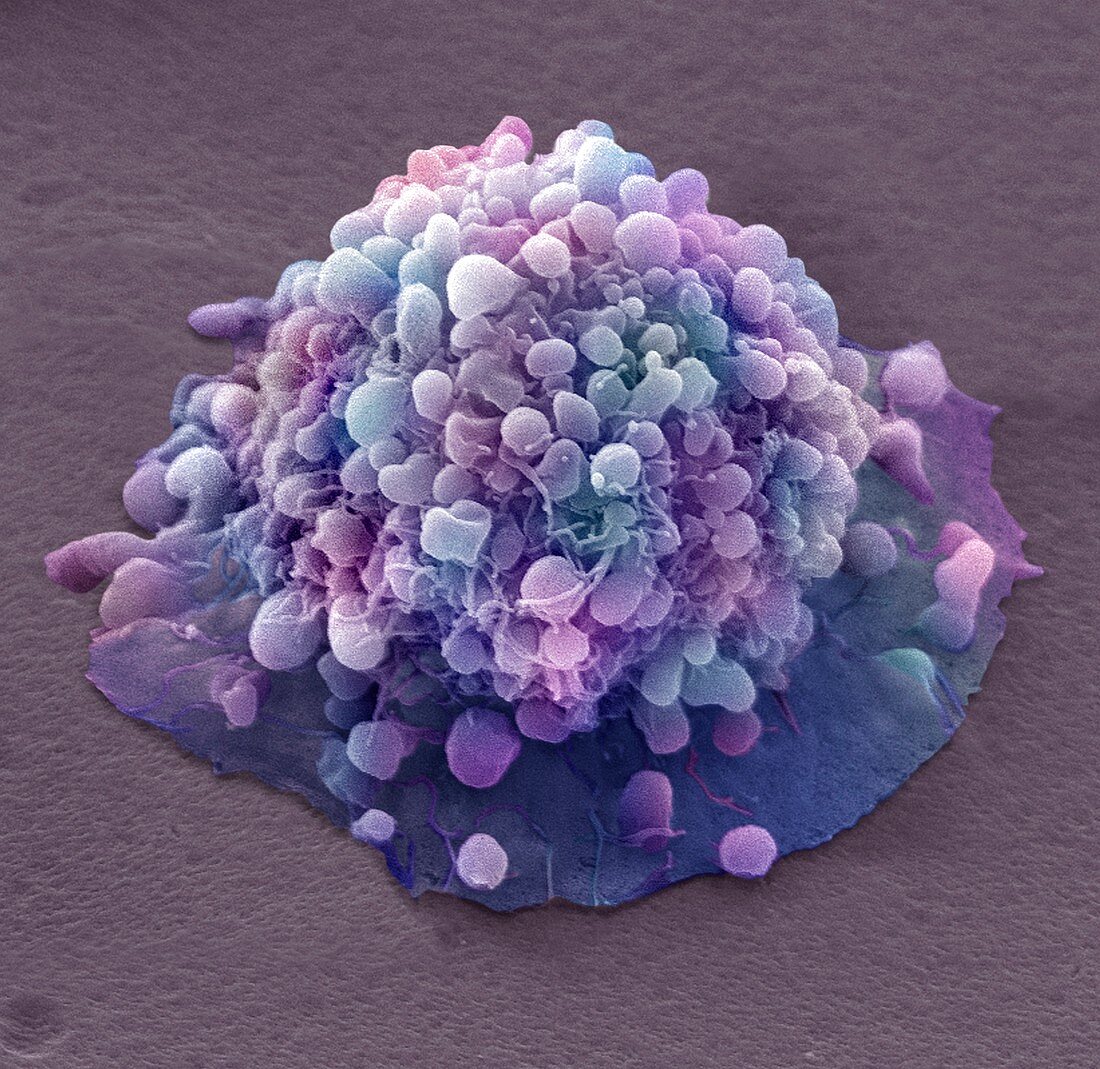 Cervical cancer cell,SEM