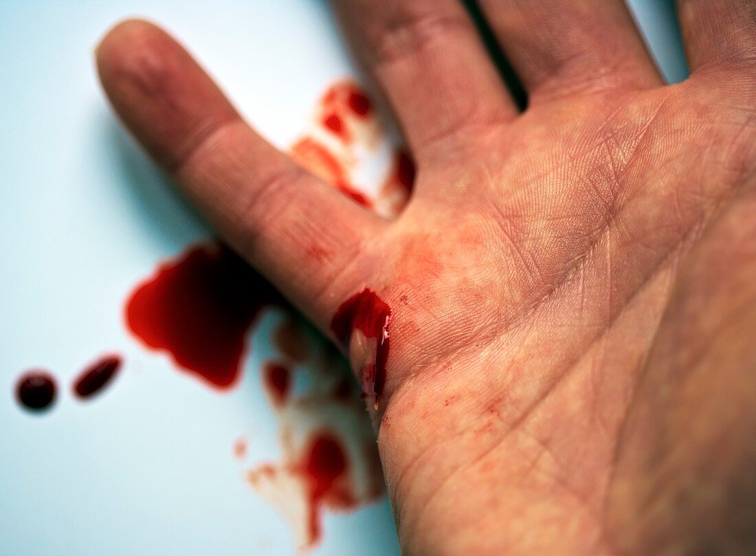 Bleeding cut on hand