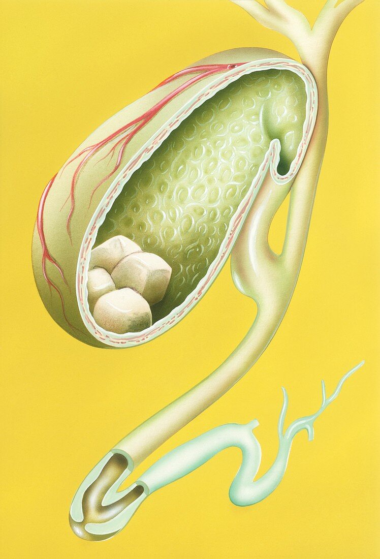 Gallstones in gallbladder,illustration