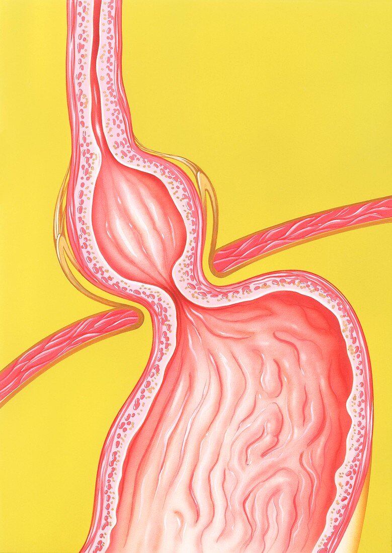 Hiatus hernia,illustration