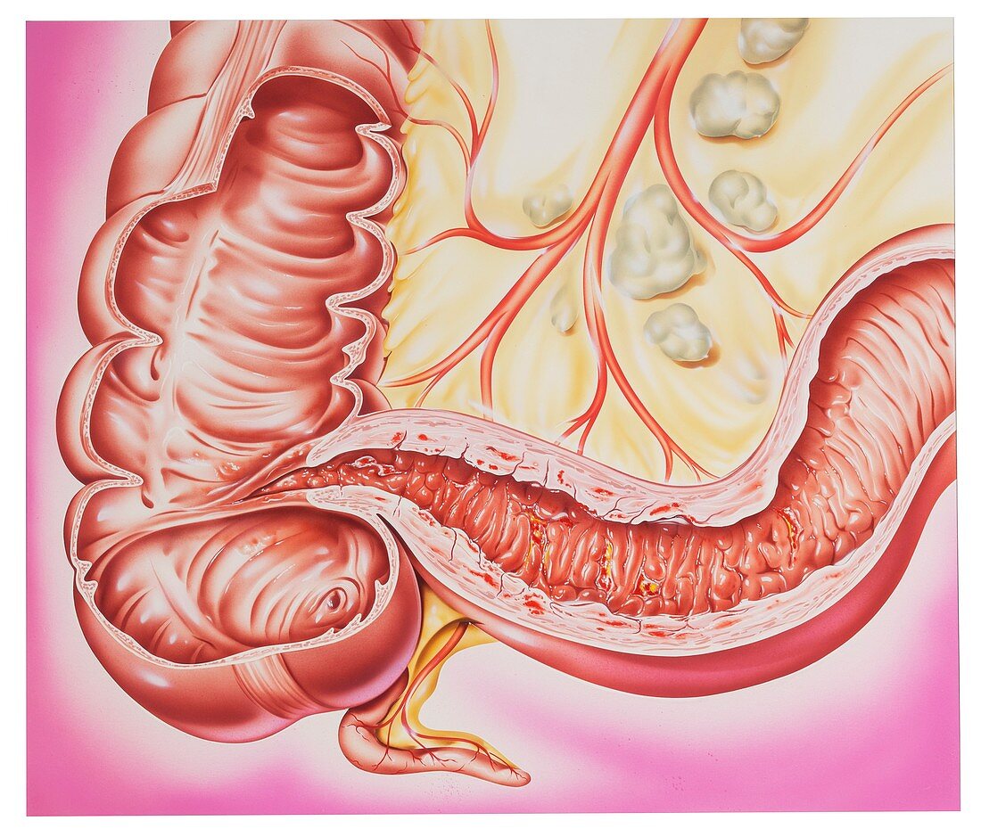Crohn's disease,illustration