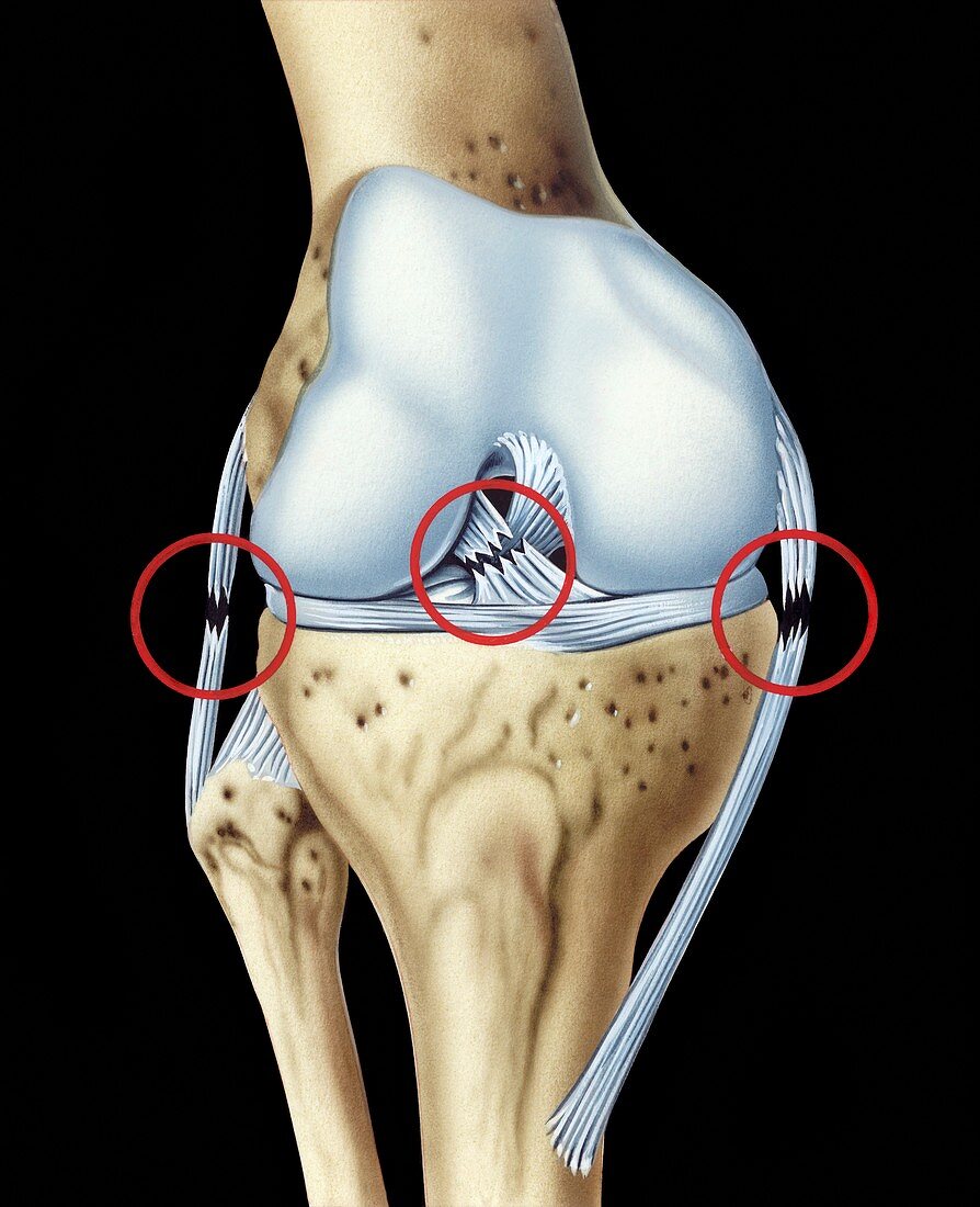 Knee ligament injuries,illustration