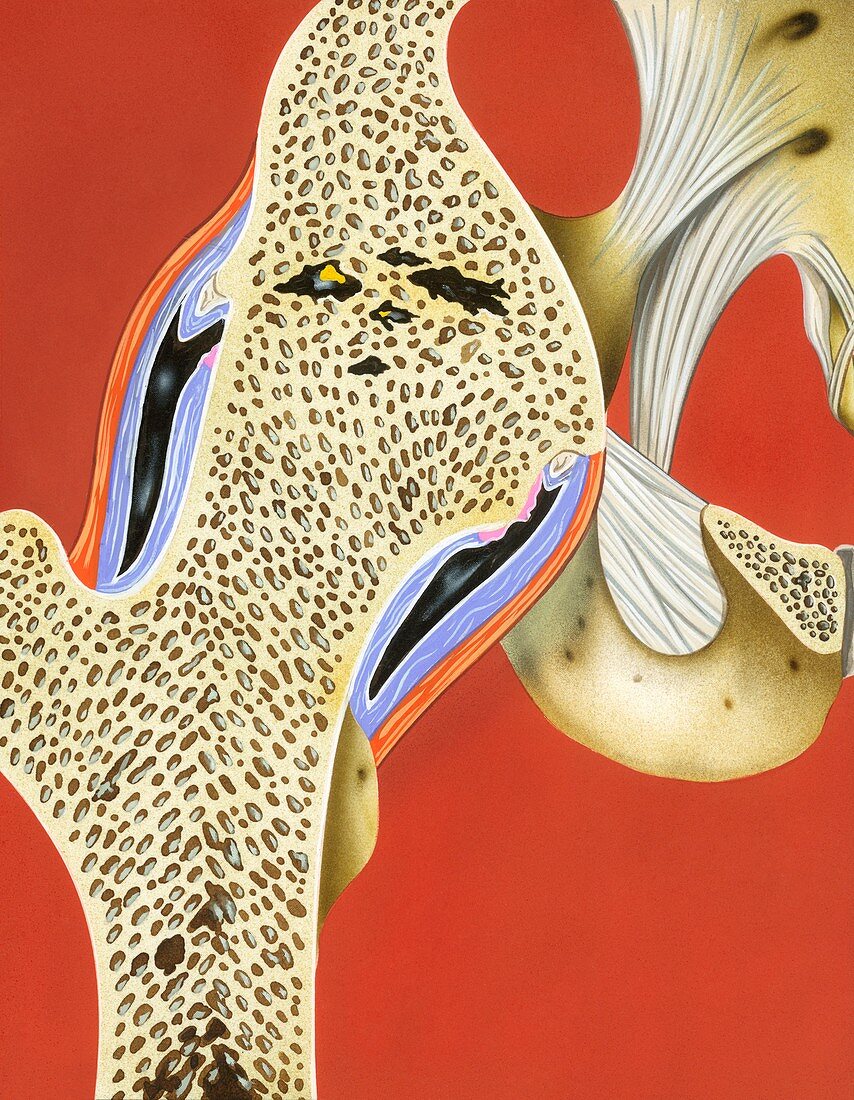 Hip joint bony ankylosis,illustration