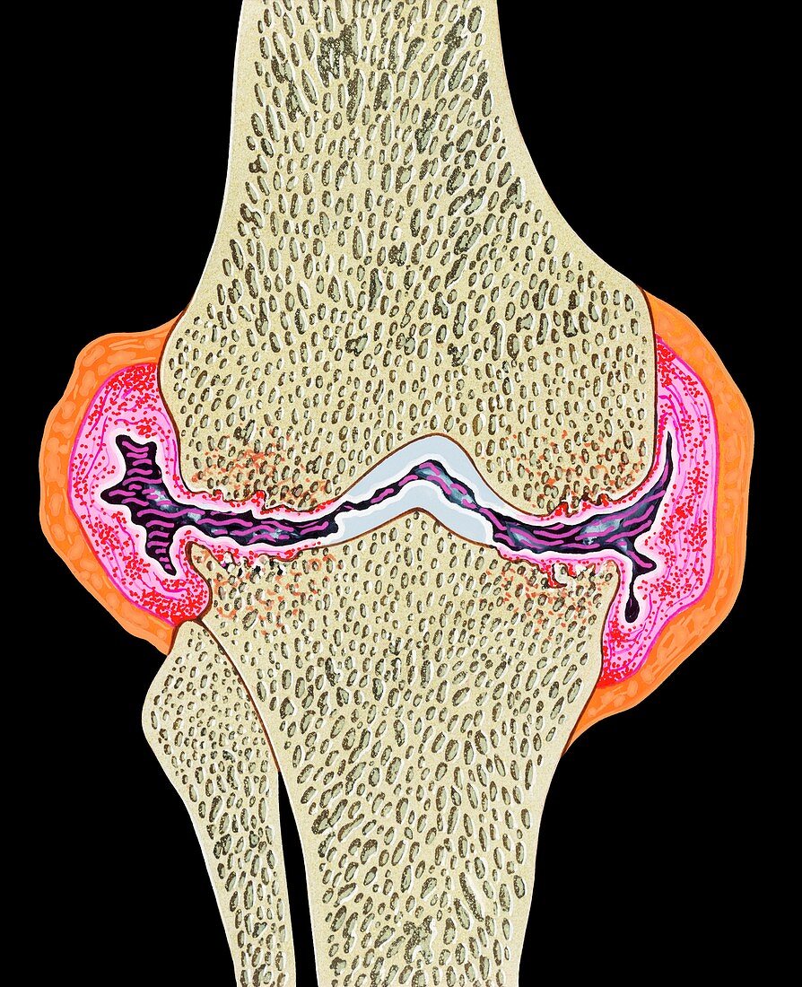 Rheumatoid arthritis,illustration