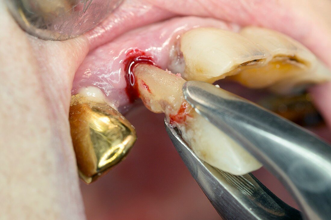 Incisor tooth extraction
