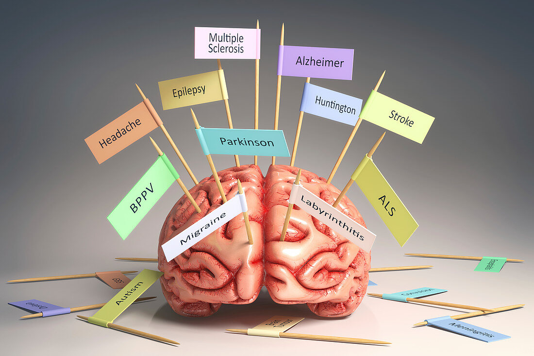 Human brain with medical conditions