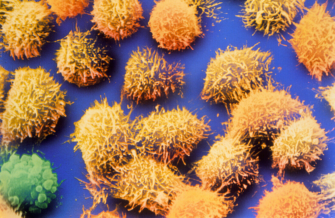 Coloured SEM of cultured HeLa cancer cells