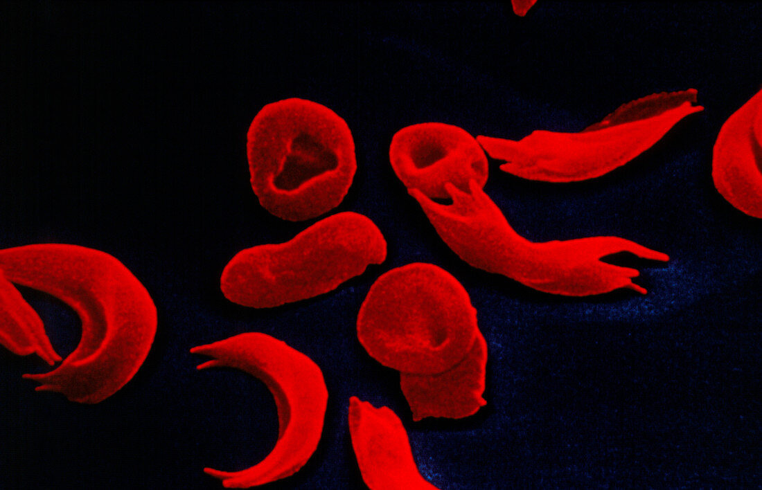 Coloured SEM of blood in sickle cell anaemia