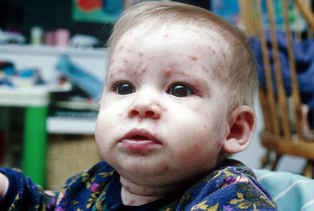 Chicken pox on infant