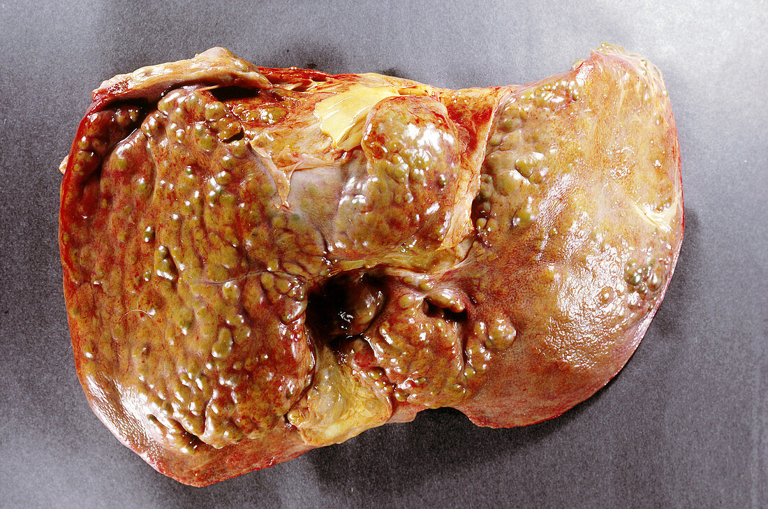 Human liver with cirrhosis and hepatitis