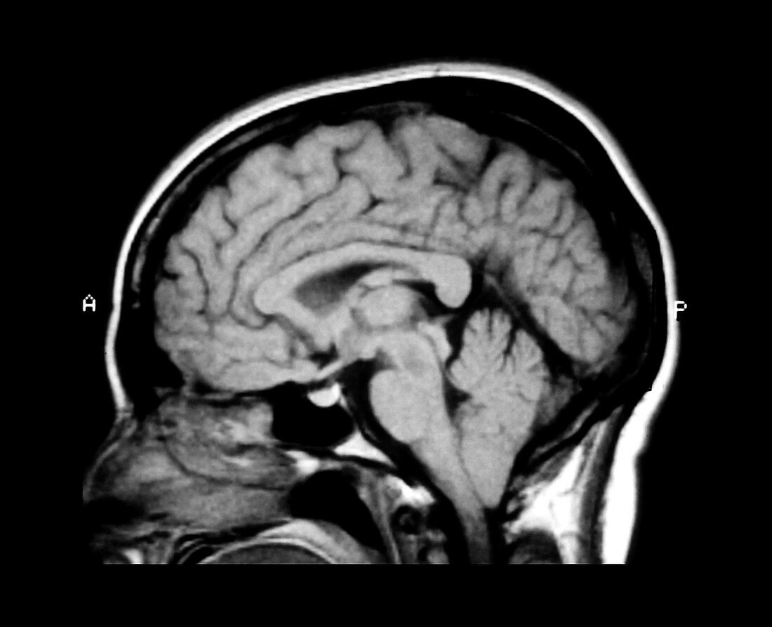 MRI of Chiari I Malformation