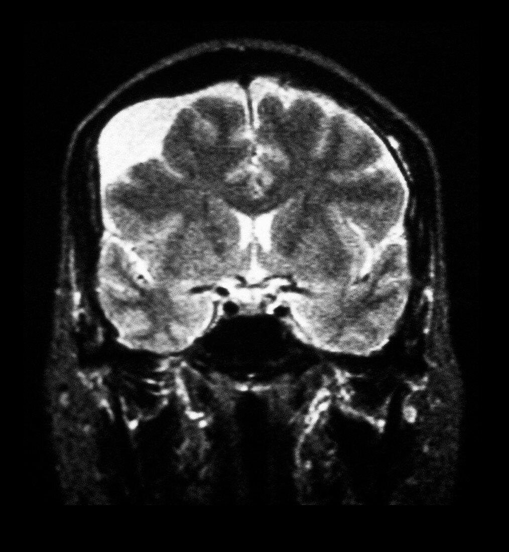 MRI of Arachnoid Cyst