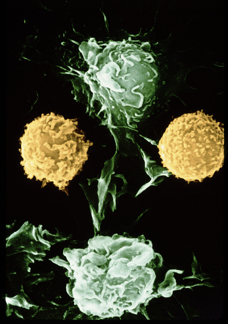 Coloured SEM of cancer cells and lymphocytes