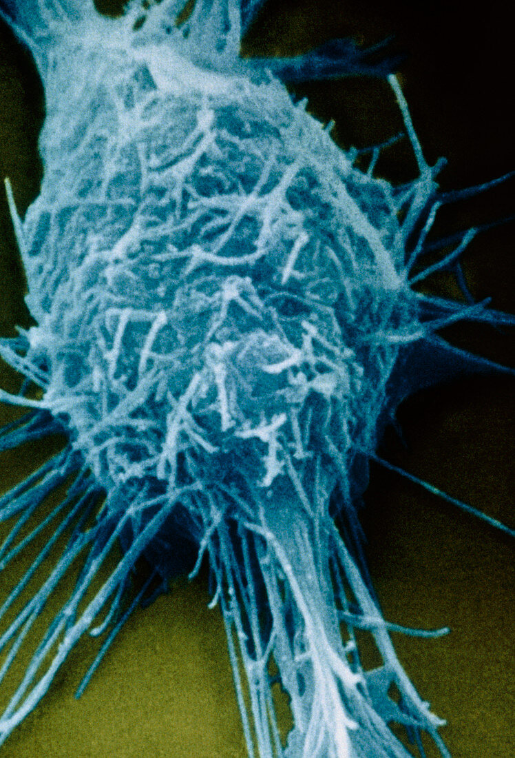 Neuroblastoma cancer cell,SEM