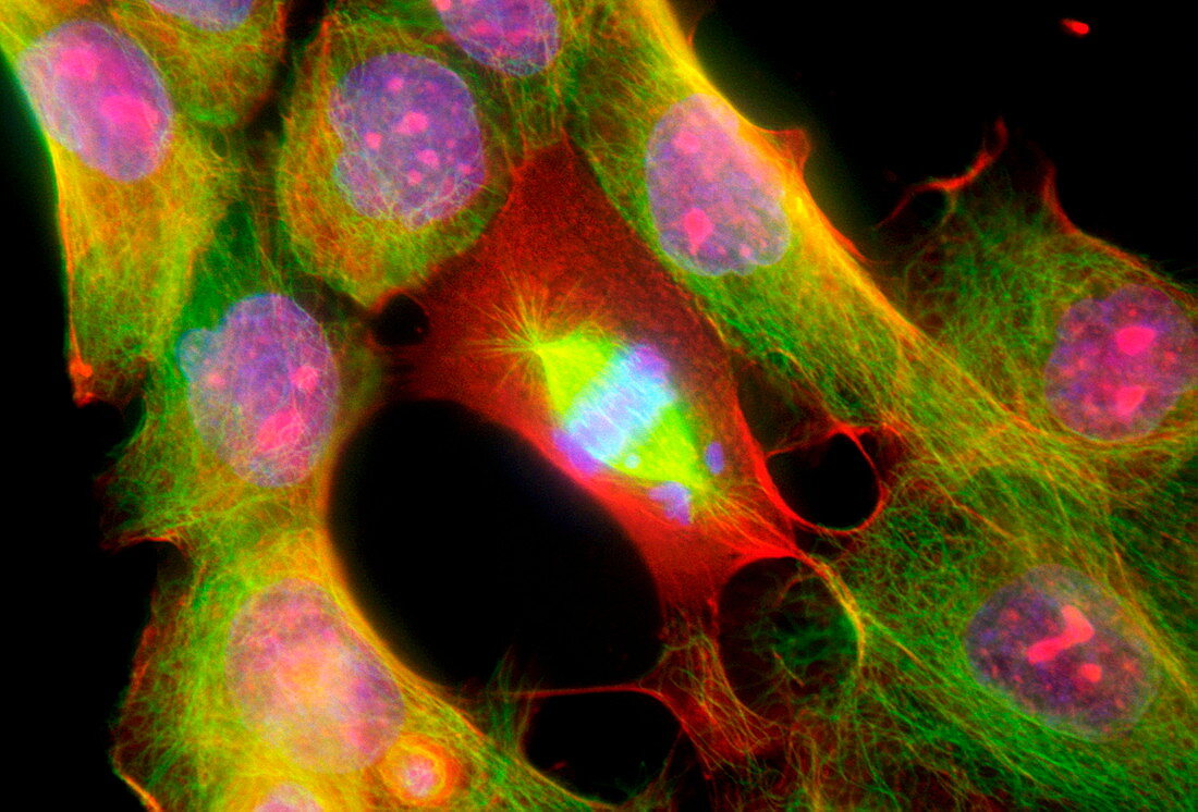 Cancer cells, light micrograph