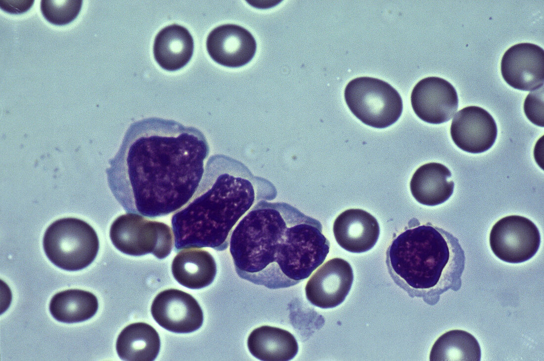 Leukemia