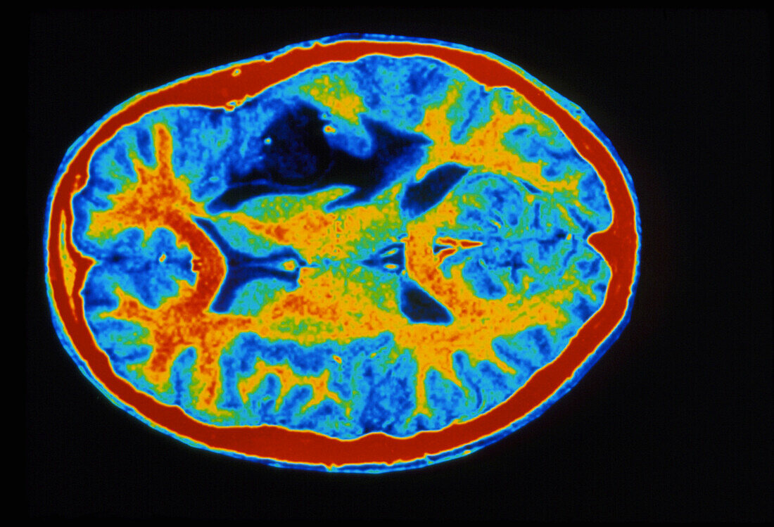 Coloured MRI scan of brain cancer (glioma)