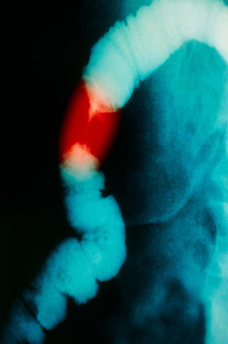 Colon cancer,X-ray