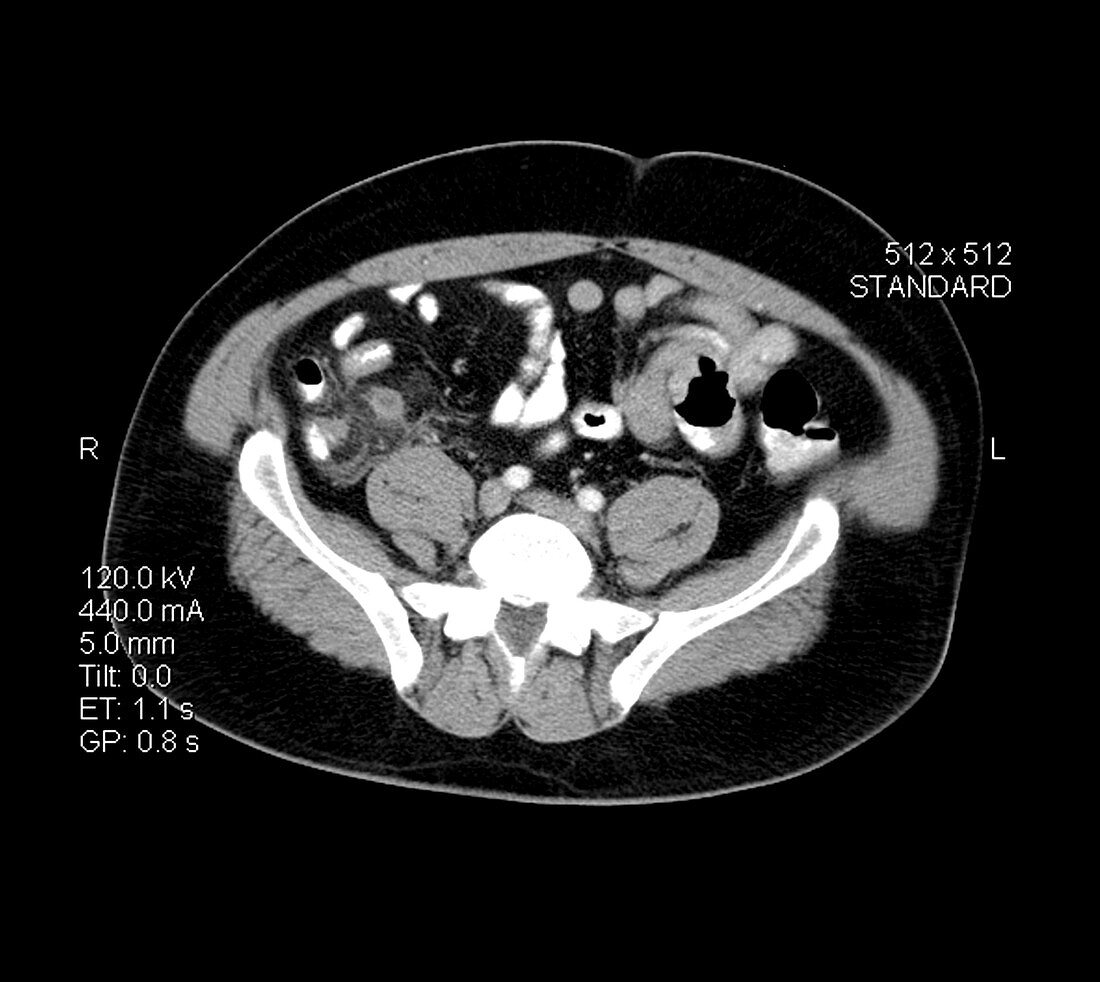 CT of Acute Appendicitis