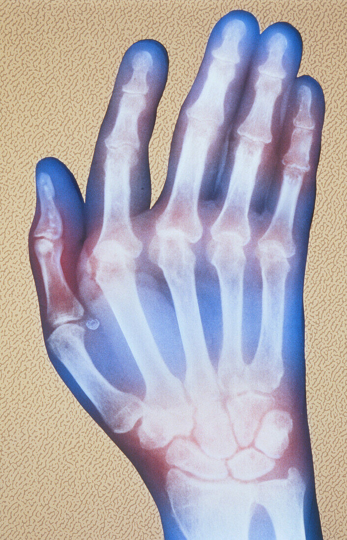 Coloured X-ray of hand with rheumatoid arthritis