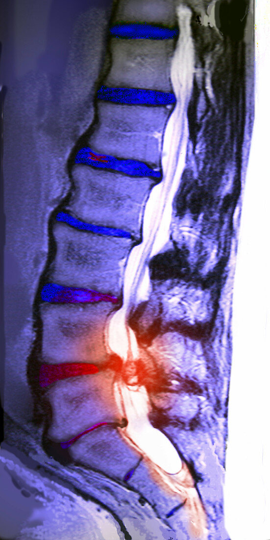 Arthritic Spine