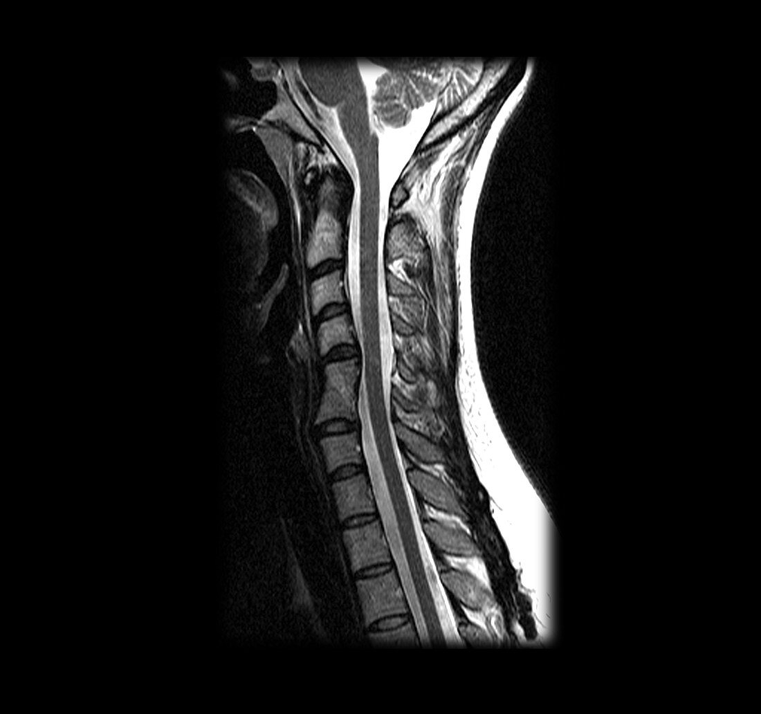 MRI of cervical spine