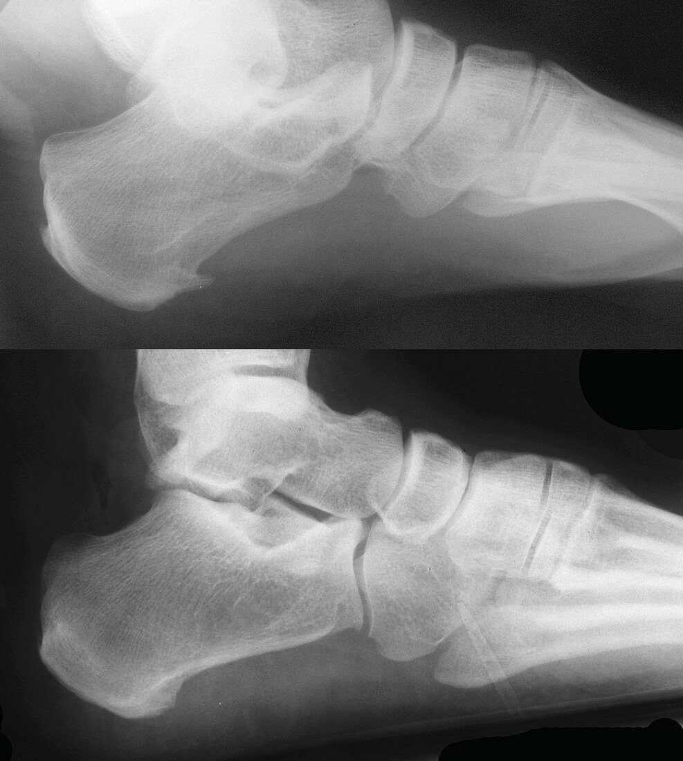 Bone Spur X-Rays