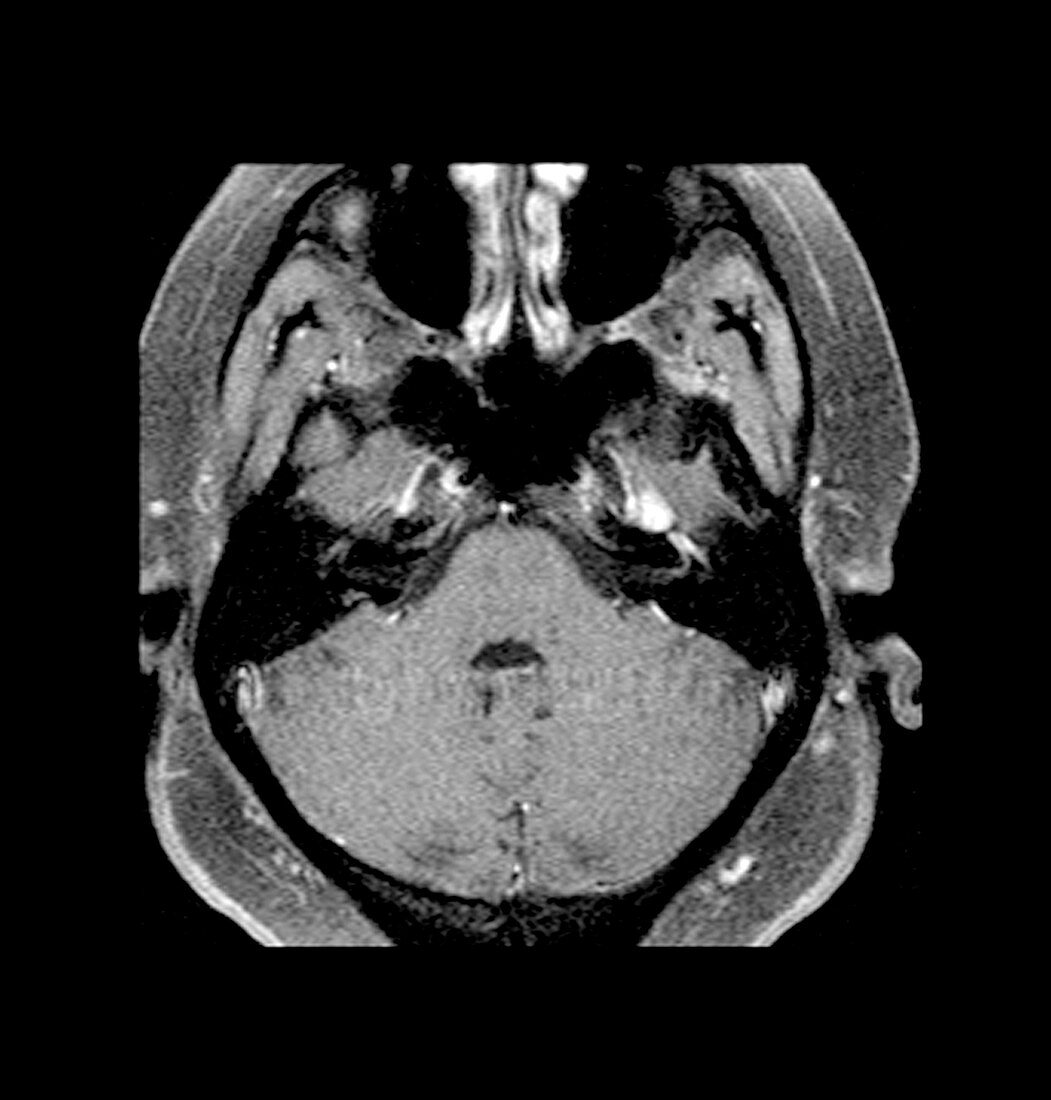 Bell's Palsy