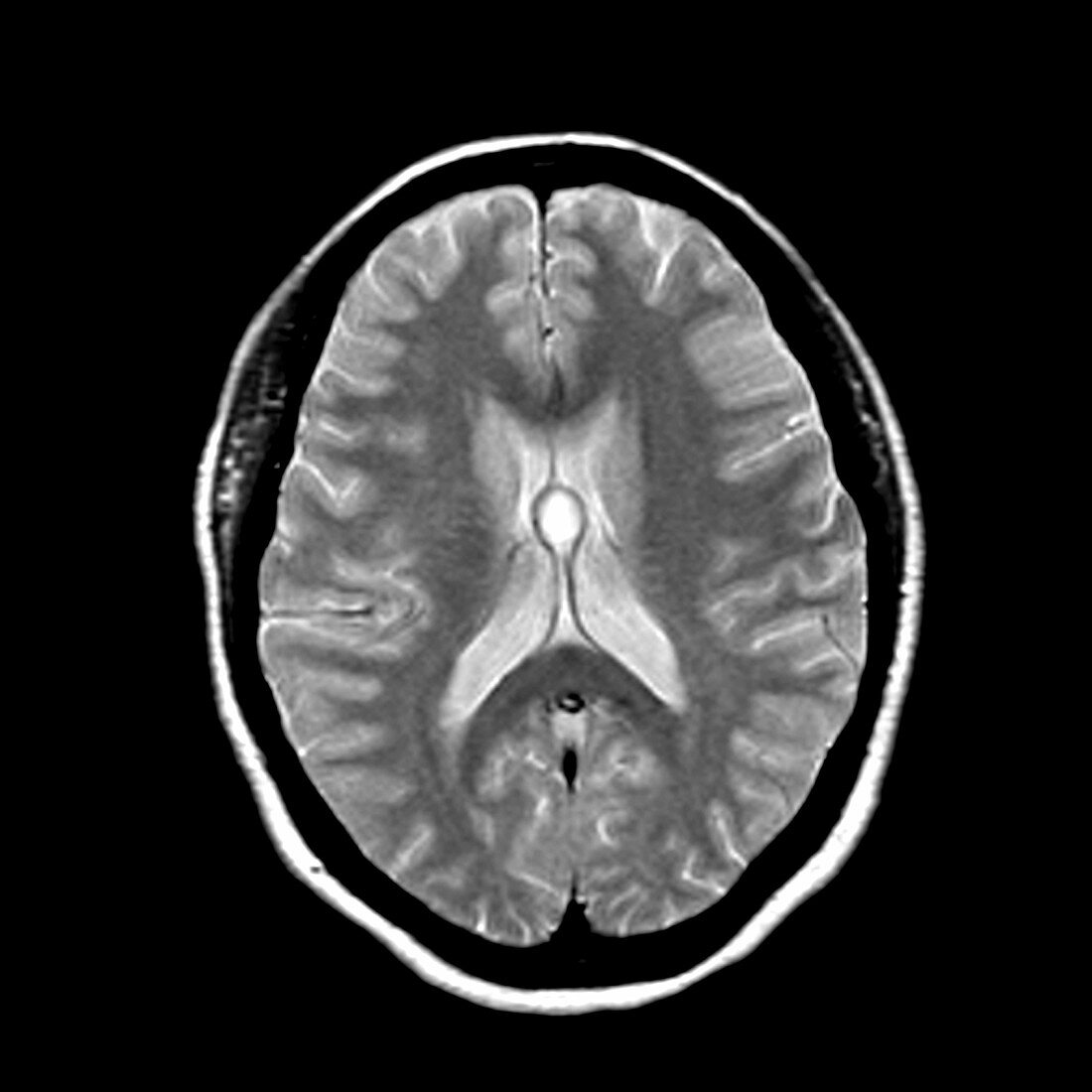 Colloid Cyst in the Human Brain
