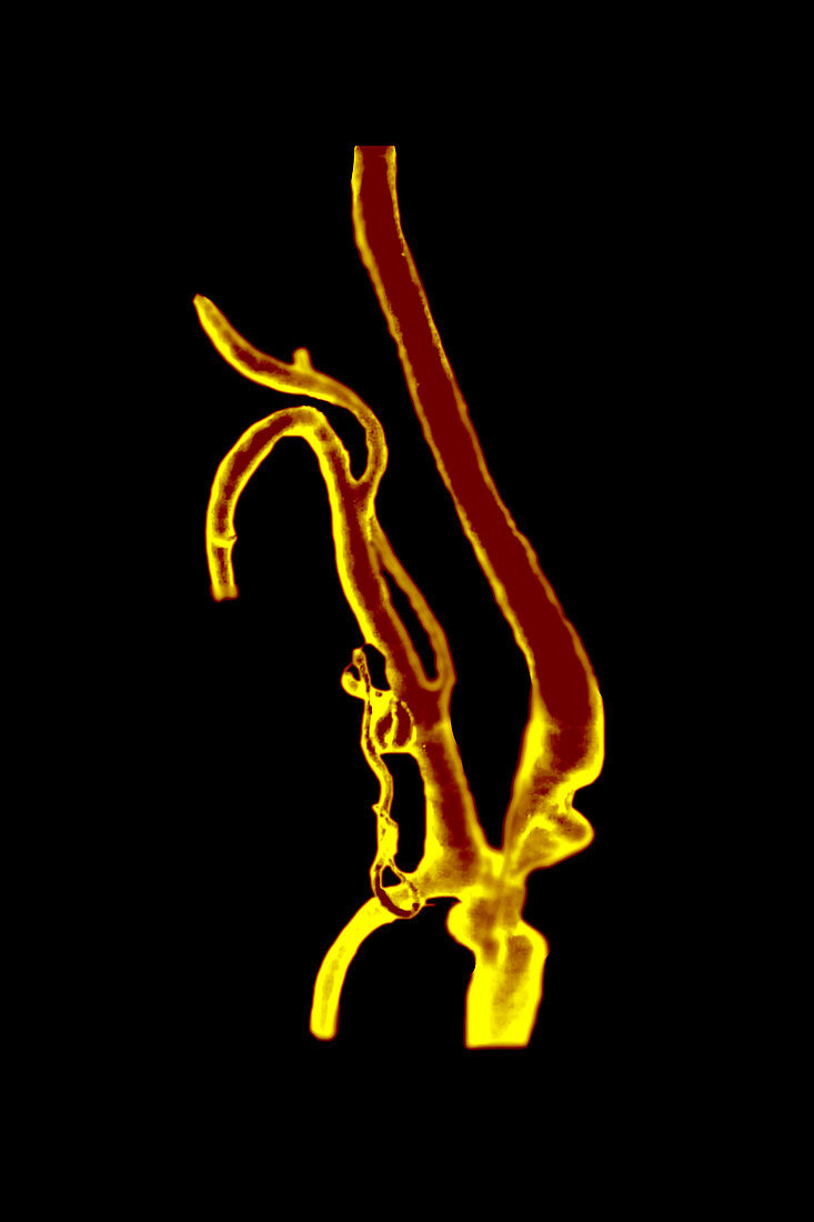 3D Angiogram of Ulcerated Stenosis