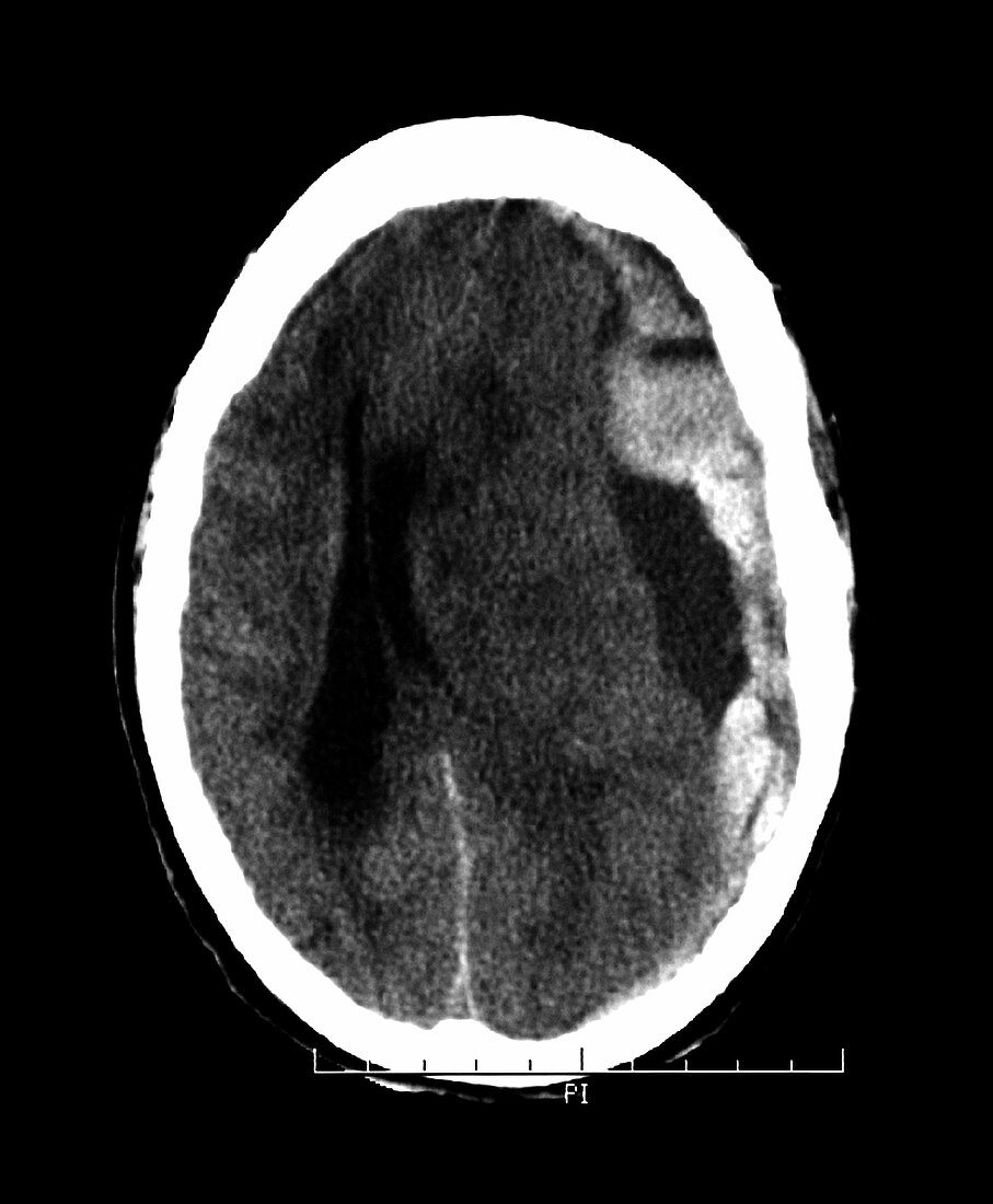 CT of Subdural Hematoma