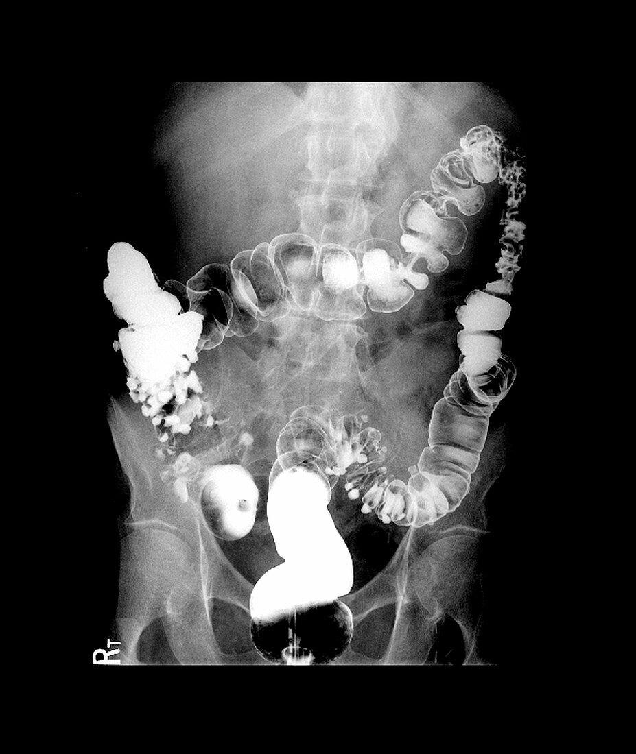 Diverticulosis in the Large Intestine