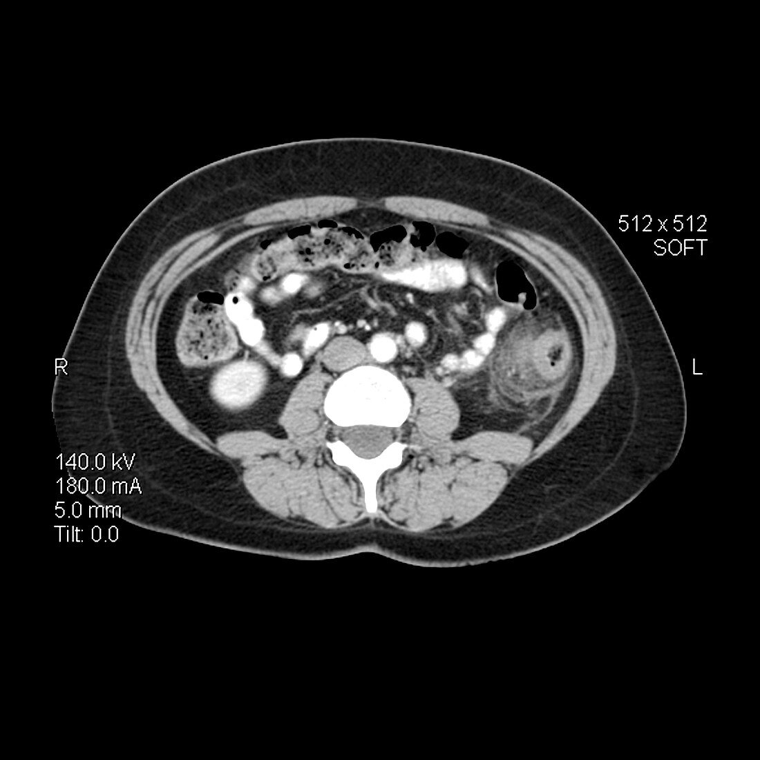 CT image of Diverticulitis