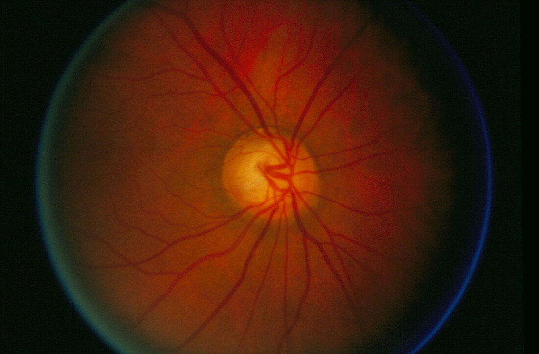 Ophthalmoscope view of an eye with glaucoma