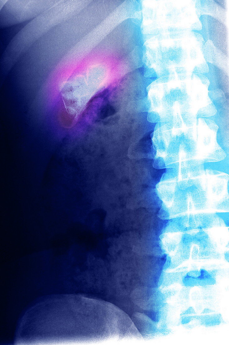 Gallstones,X-ray