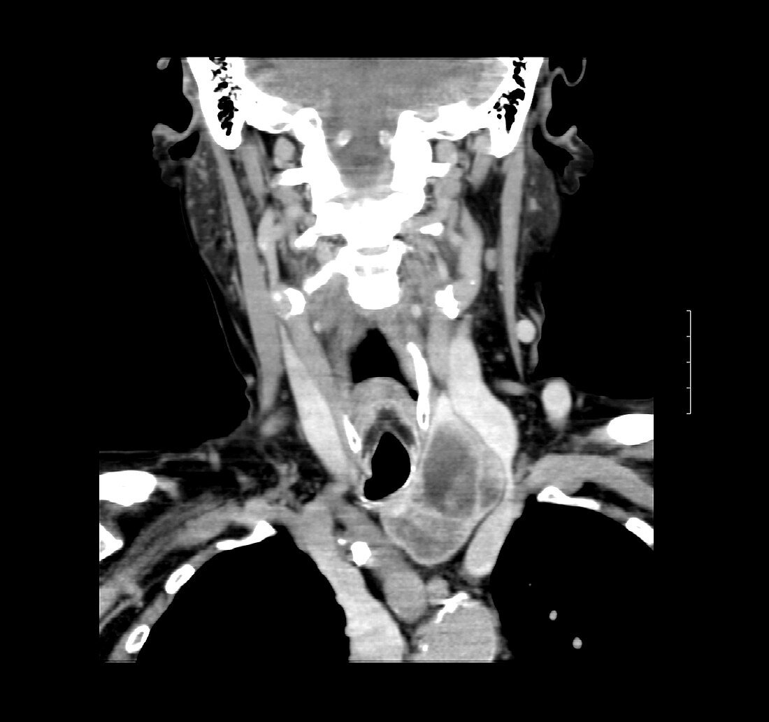 CT of neck showing thyroid goiter