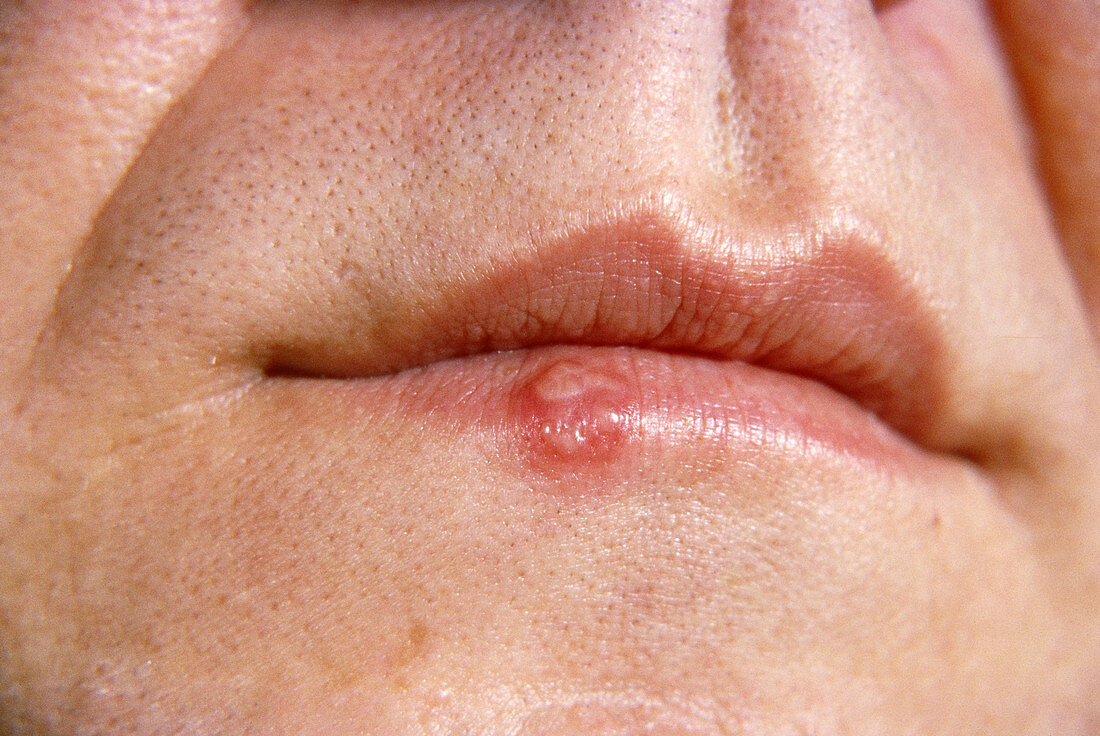 Herpes Cold Sore