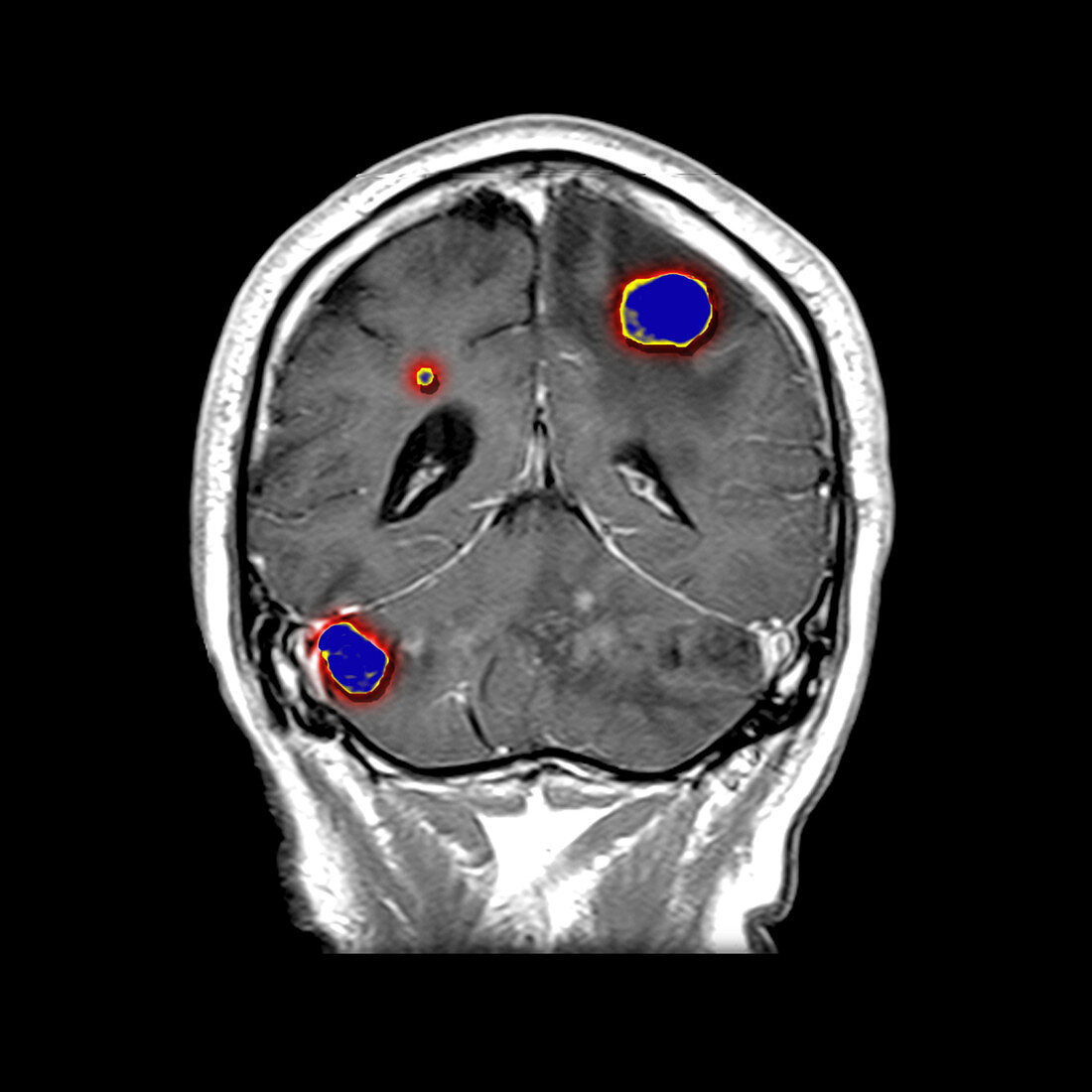 Brain tumors
