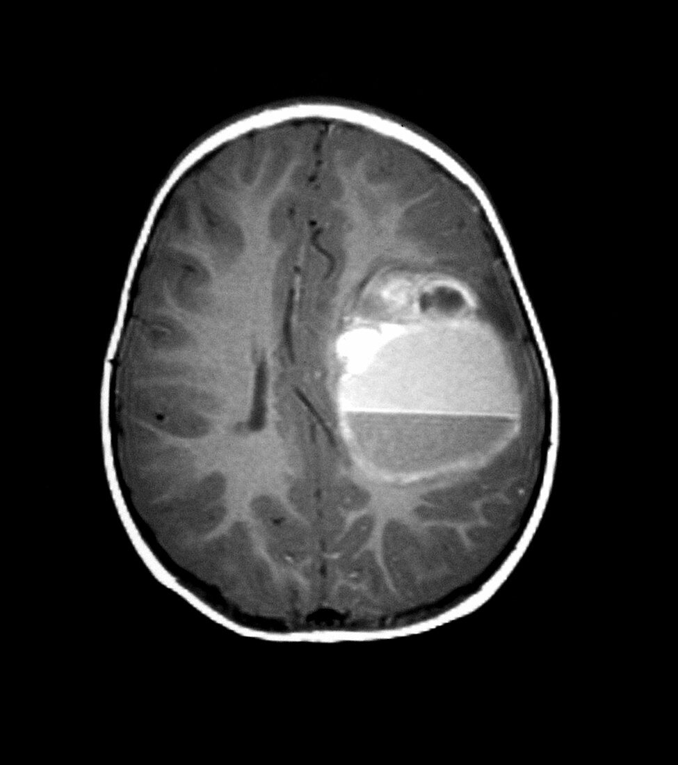 MRI of PNET
