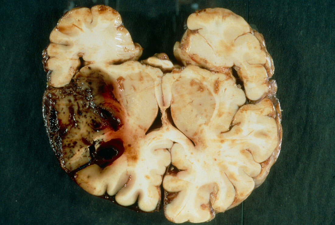 Section of brain with intracerebral haemorrhage