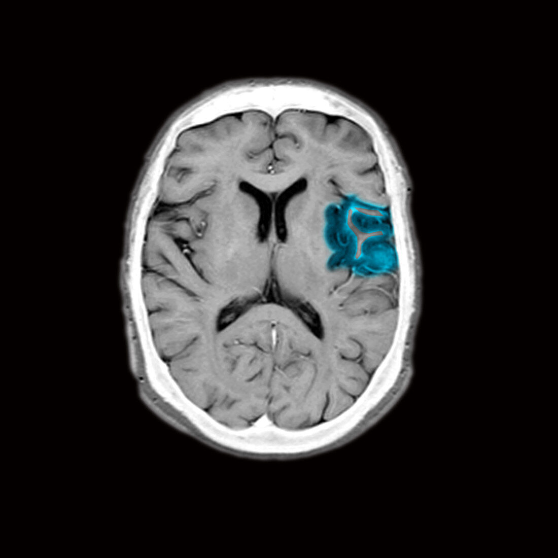 MRI of brain with acute stroke