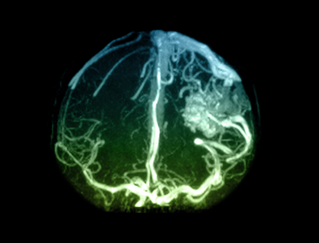 Parietal lobe arterial venous malformation