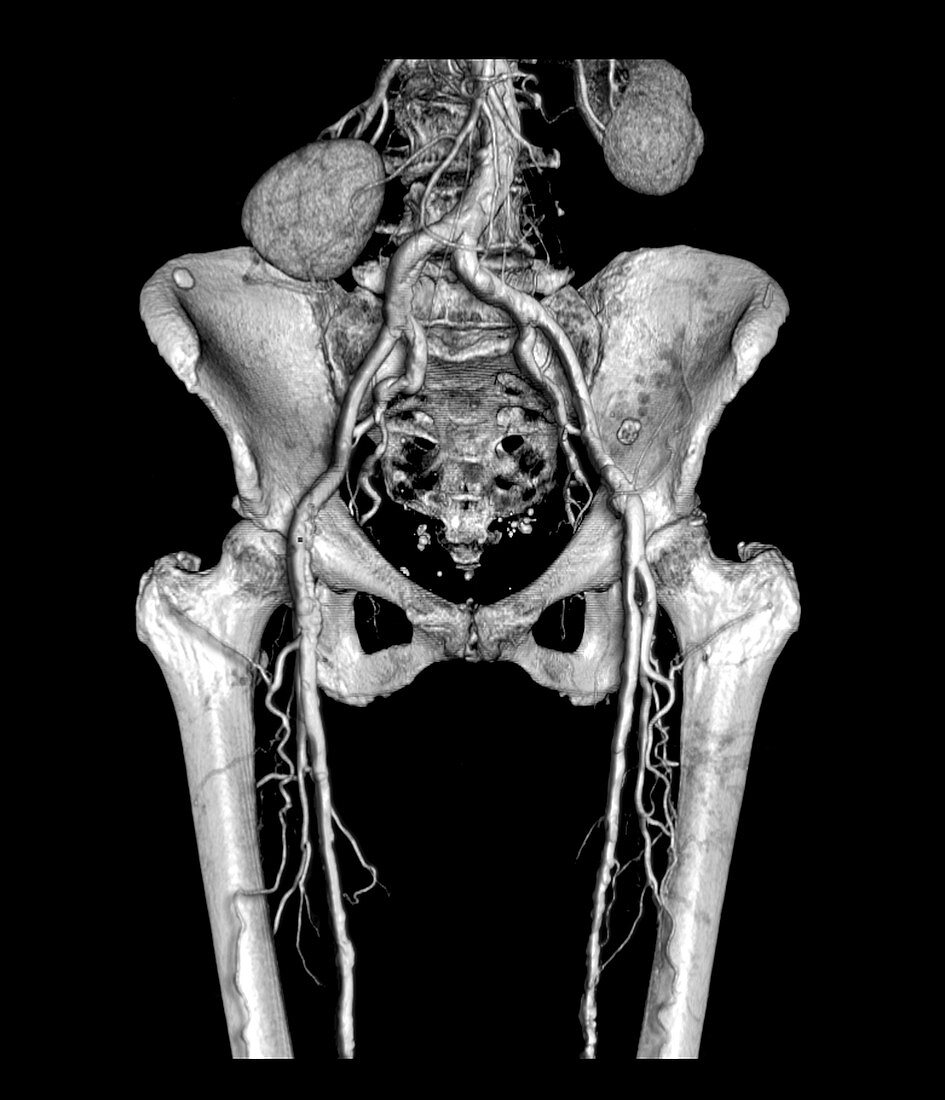 Pelvis and Upper legs with Arteriosclerosis