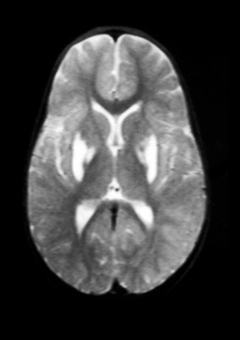 MRI of Infant with Leigh's Disease