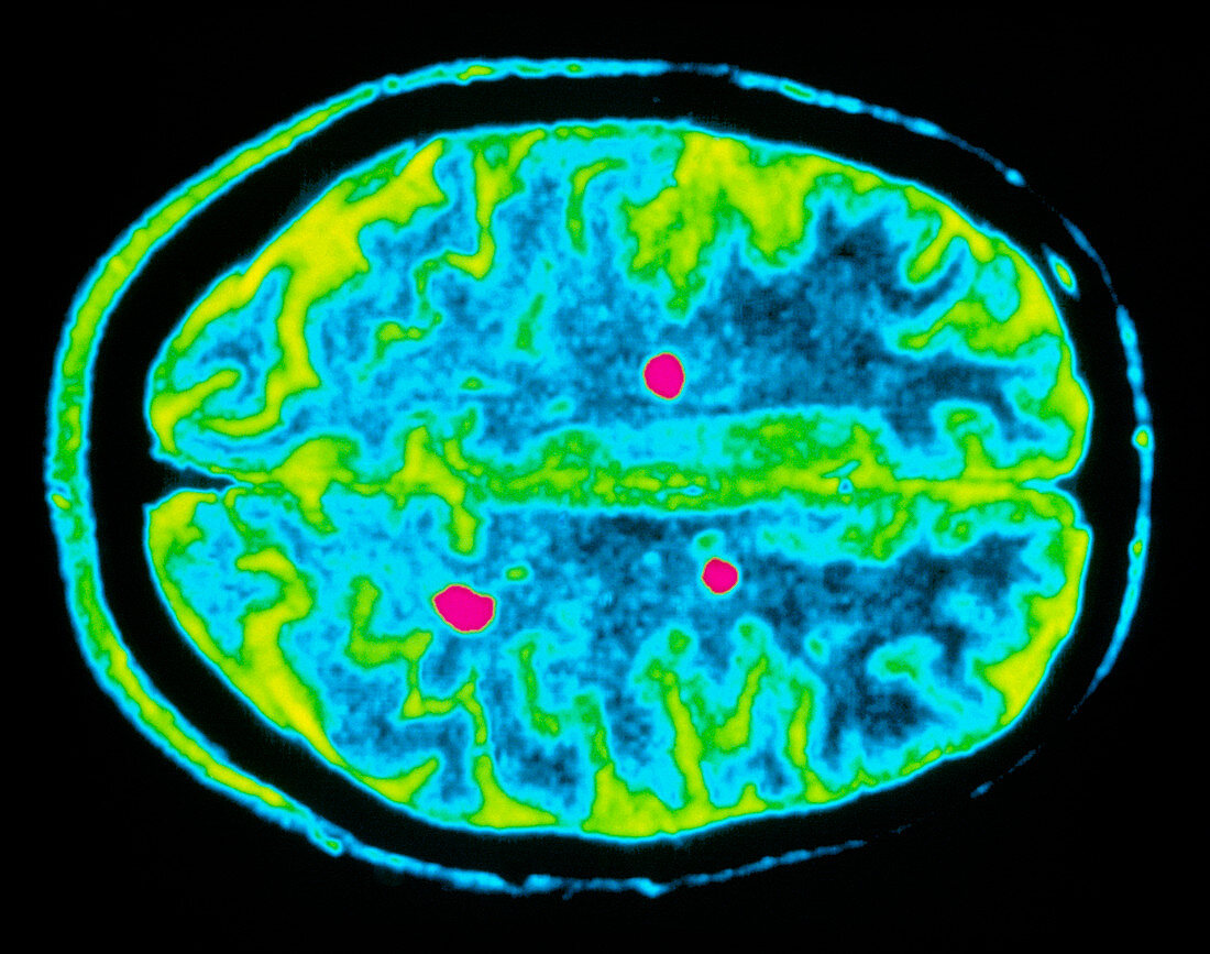 Col MRI brain scan of a multiple sclerosis patient